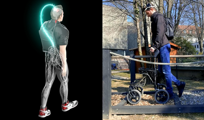 Implante con IA devuelve la movilidad a un hombre tetrapléjico después de tres años